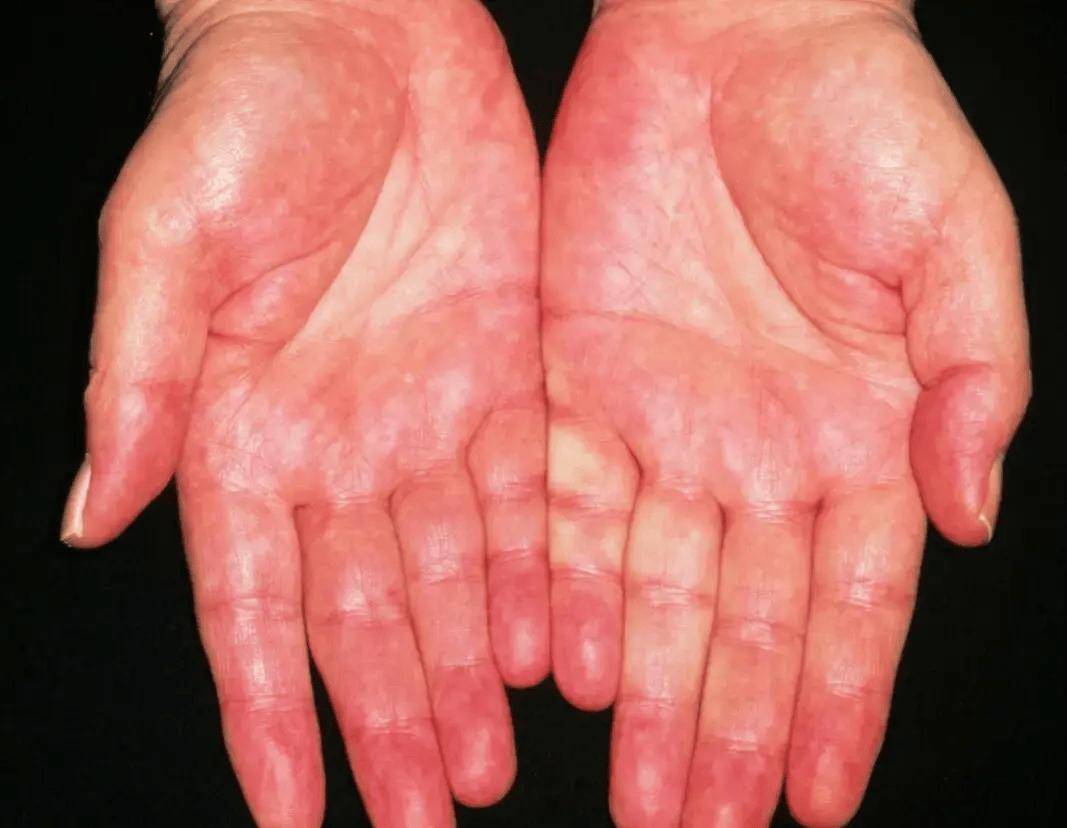 医生:手部3异常,多半是血管堵了