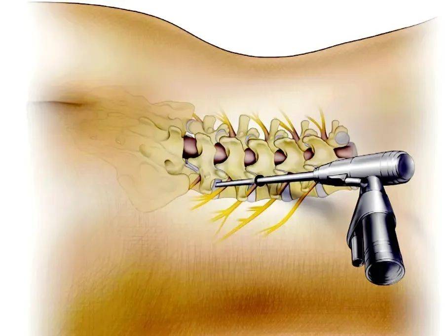 腰间盘融合术图片