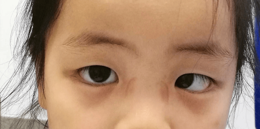 3-6岁儿童常见眼病系列: