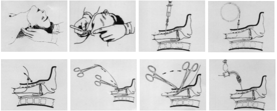 气管切开术步骤图解图片