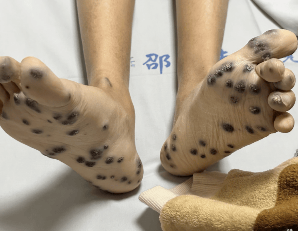 门诊患者全身长满「蓝莓」,20年查不出原因,只换了一种药,病好了