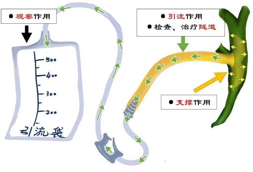 胆总管t型管拔管图图片