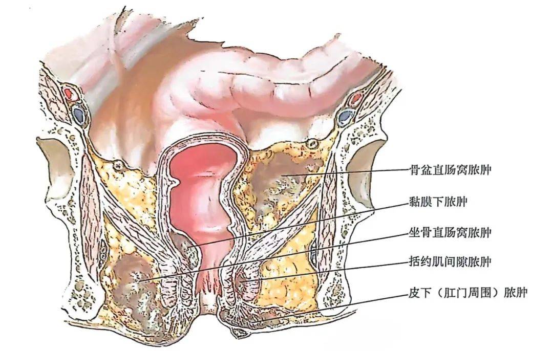 直肠窝的位置示意图图片