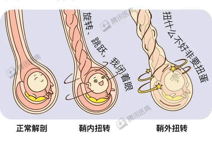 睾丸下降到阴囊的图片图片