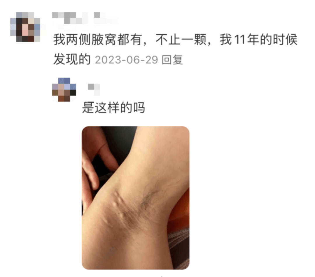 (有时也被称为「皮脂腺囊肿」,但这个叫法不准确)图片来源:aocd