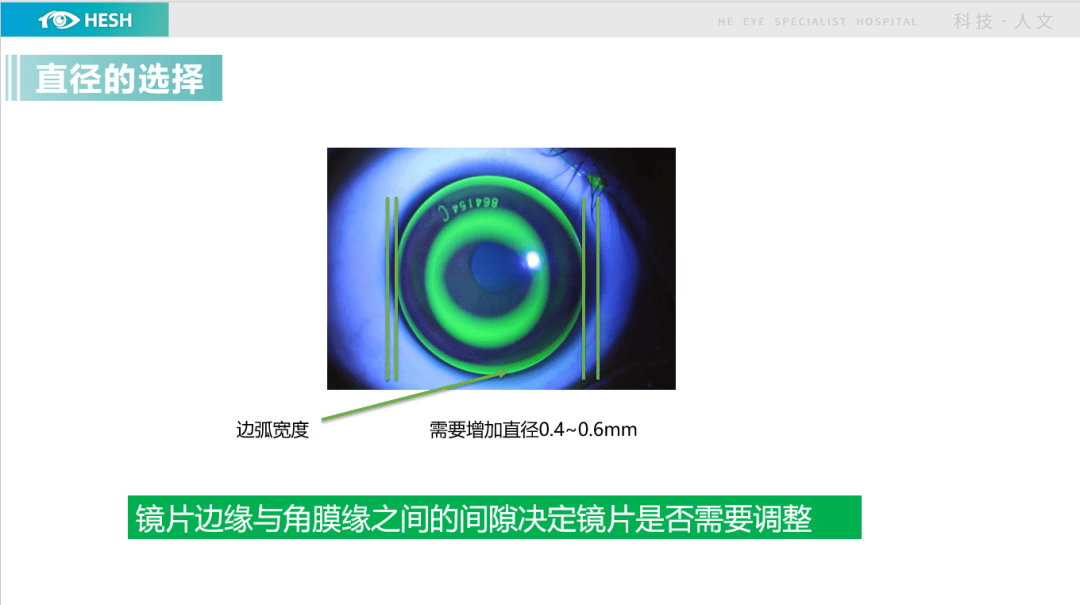 角膜塑形镜松紧配时图图片