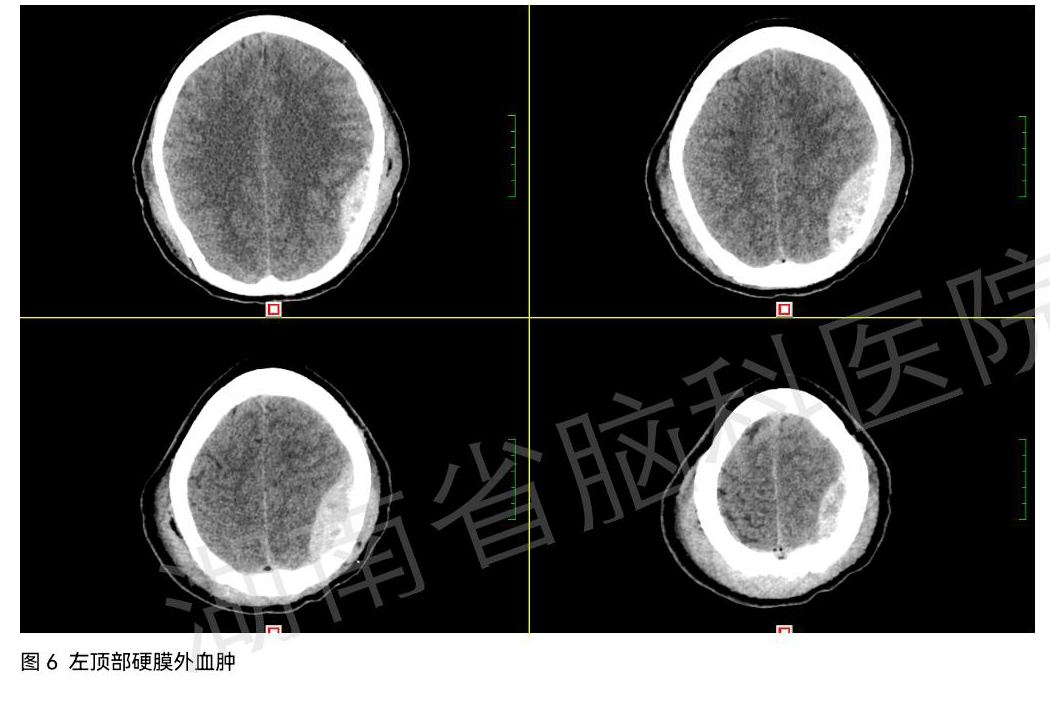 头颅硬膜图片