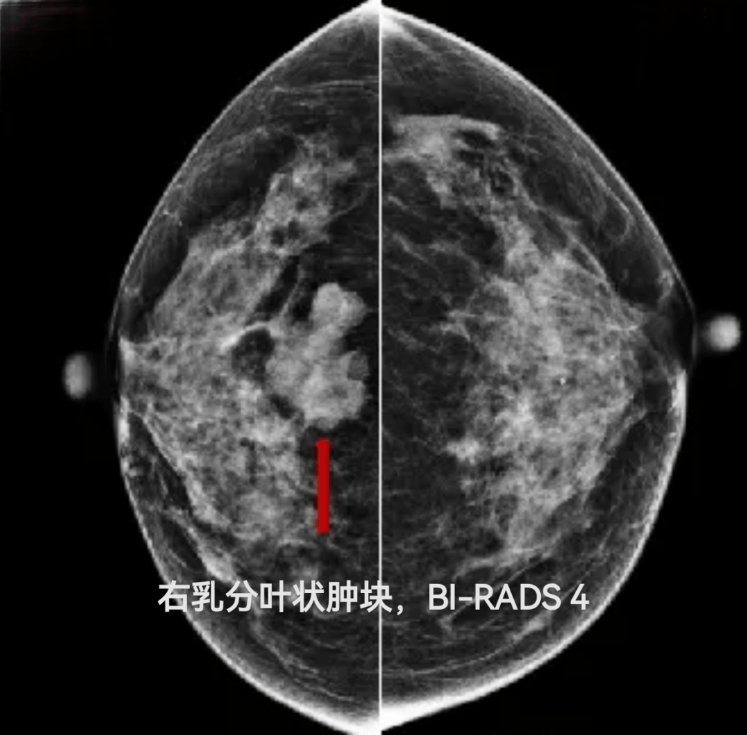 乳腺钼靶报告轻松看懂不求人