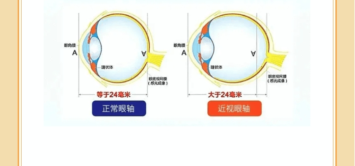 角膜曲率和近视的关系图片