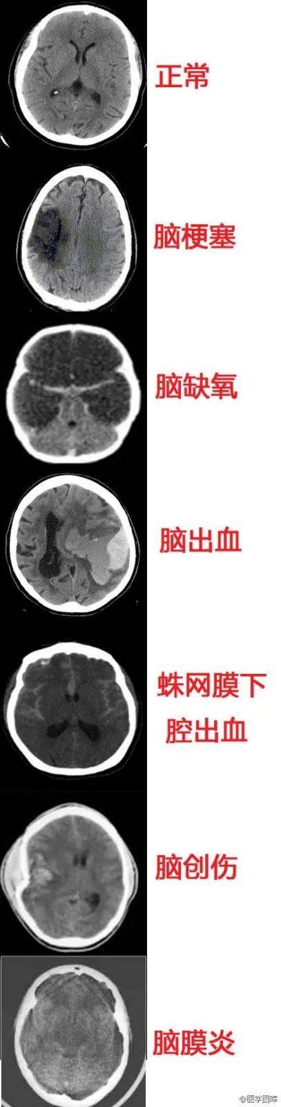 脑损伤8.不同部位脑病的瞳孔变化9.
