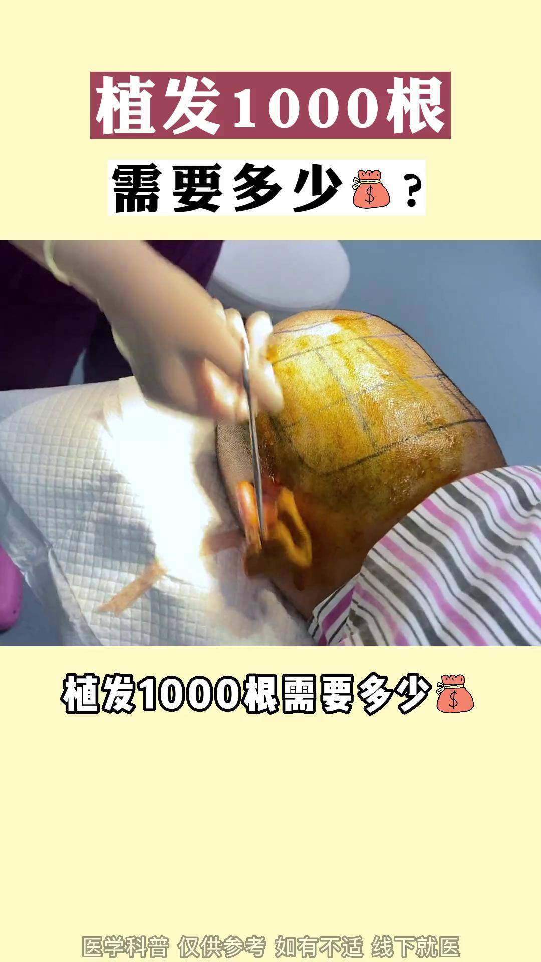 正规植发机构植发多少钱(正规植发机构植发多少钱一次)