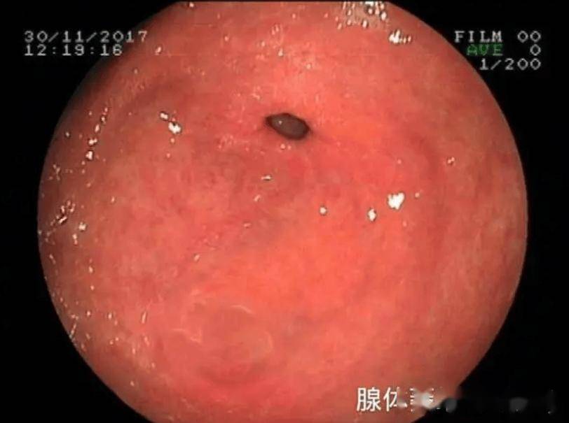 得了萎缩性胃炎,该怎么办?