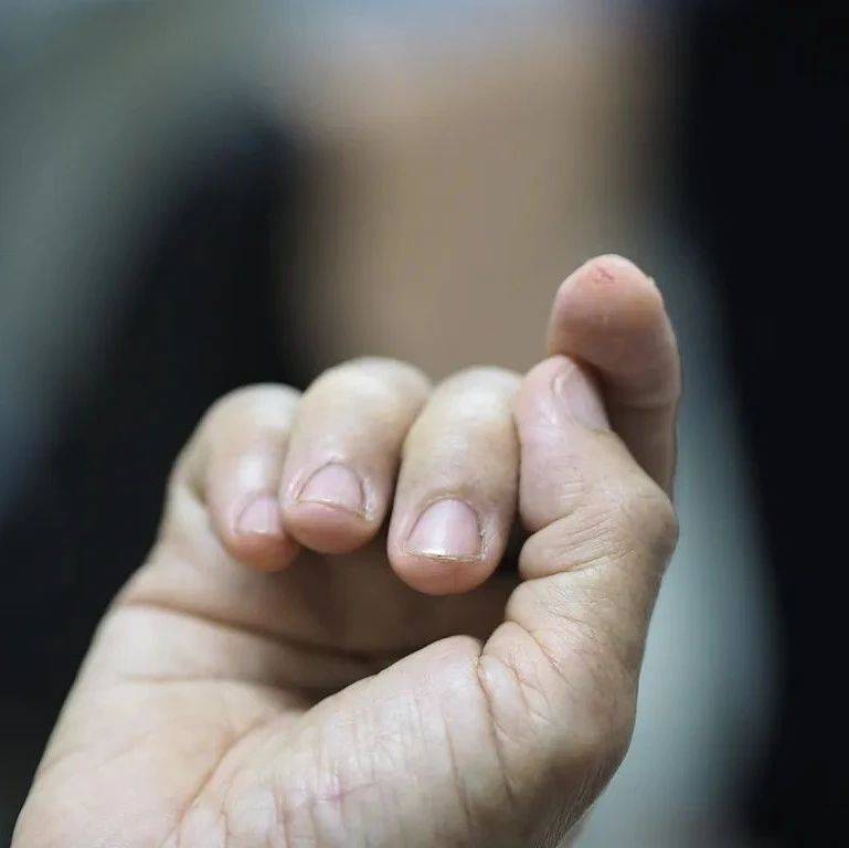 【1024·提醒】老婆婆被它划伤手指送进ICU,这些伤口不可大意!_胡婆婆_接种_疫苗
