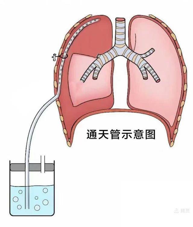 在肺上叶切除术中的应用