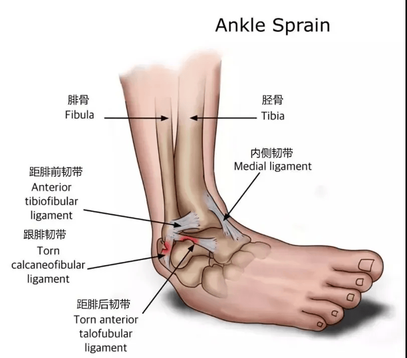 脚踝韧带撕裂症状图片