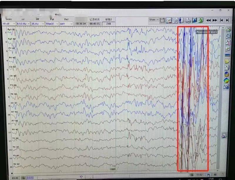 异常脑电图尖波尖慢波图片