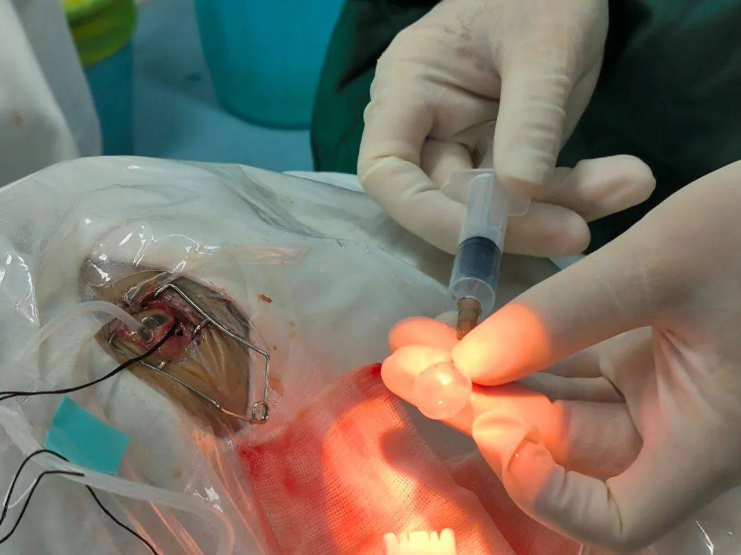 石家庄眼科医院成功开展第三代折叠式人工玻璃体球囊植入手术