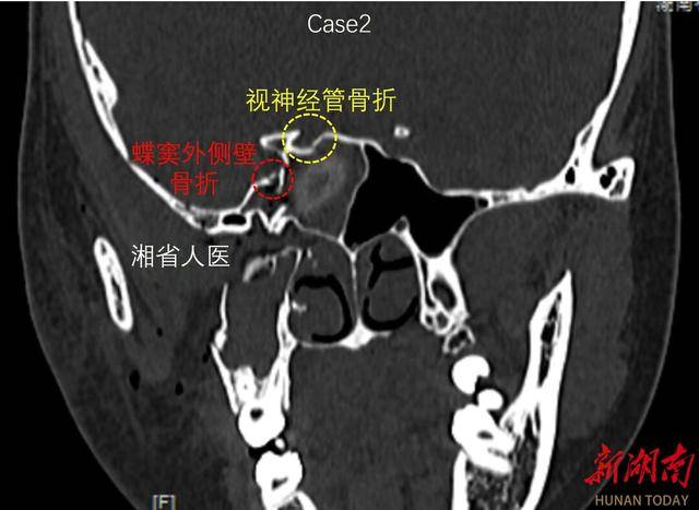 视神经颅内段图片