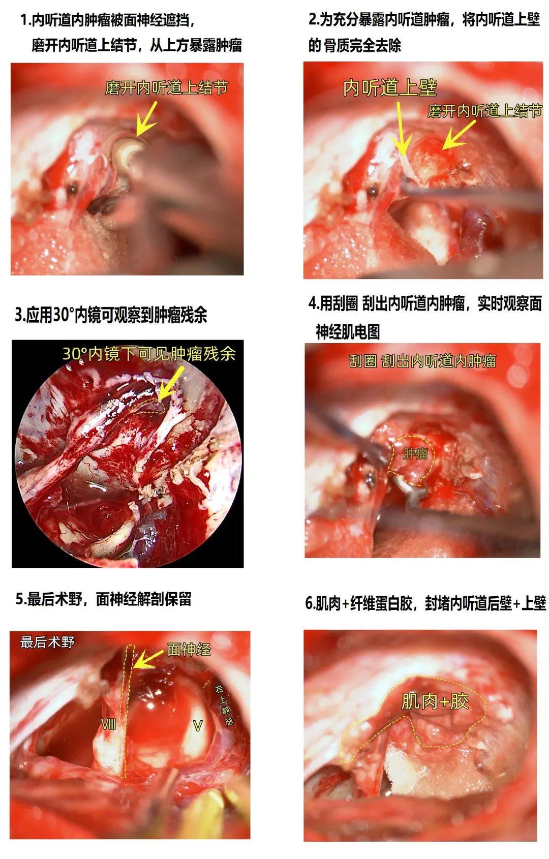 病例夹 张建富副主任医师 面神经后置