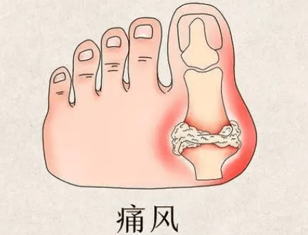 科普 | 痛风全知道(图1)