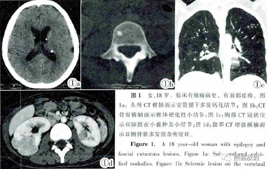 教科书般的系统性病例!过目不忘!_诊断_皮质_平滑肌