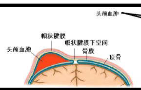 新生儿头颅血肿图片图片