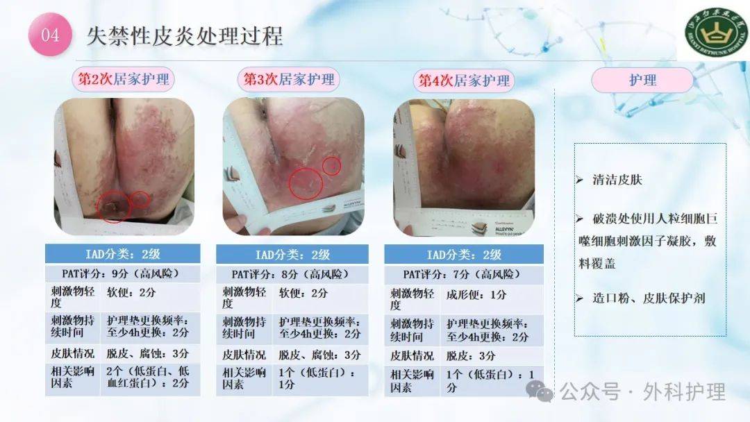 【ppt】一例骨盆骨折失禁性皮炎患者的案例分享