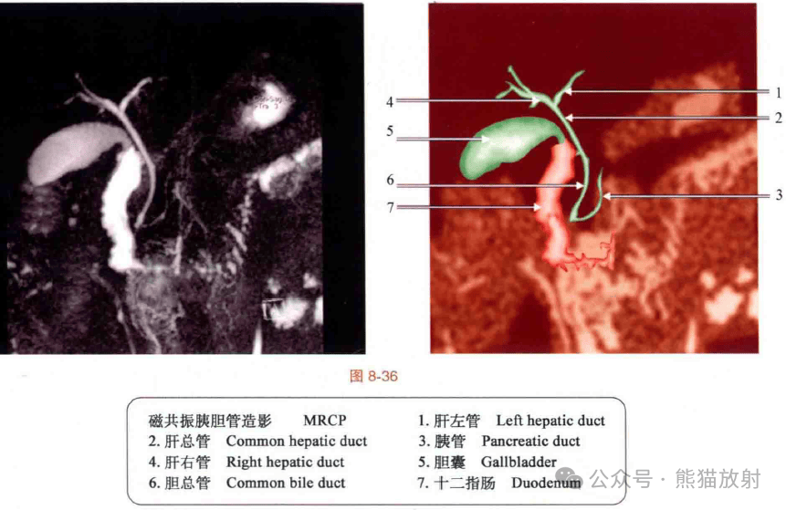 胆总管mri解剖图图片