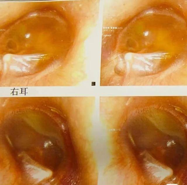 耳廓软骨膜炎,耳壳软骨膜下积液,不用怕!咱老百姓有验方