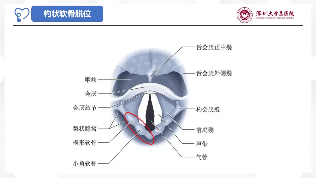 声带影像解剖图片