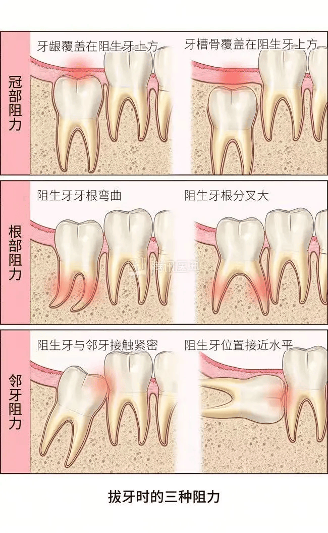 智齿是哪一颗牙齿图图片