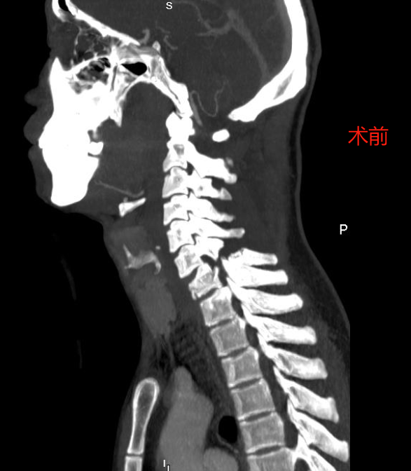 「手术禁区」市五院骨科勇闯男子车祸险瘫痪