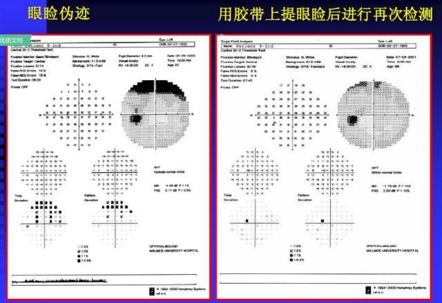 视野图右眼图片