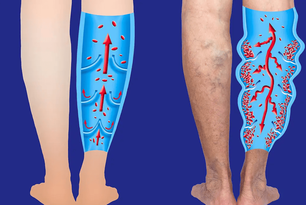 案例探讨| 一例下肢静脉血栓的护理