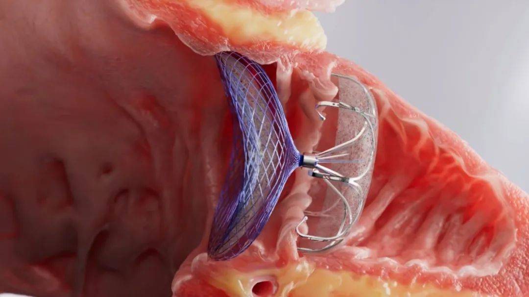 强生医疗科技重磅推出沁联双盘内塞左心耳封堵器系
