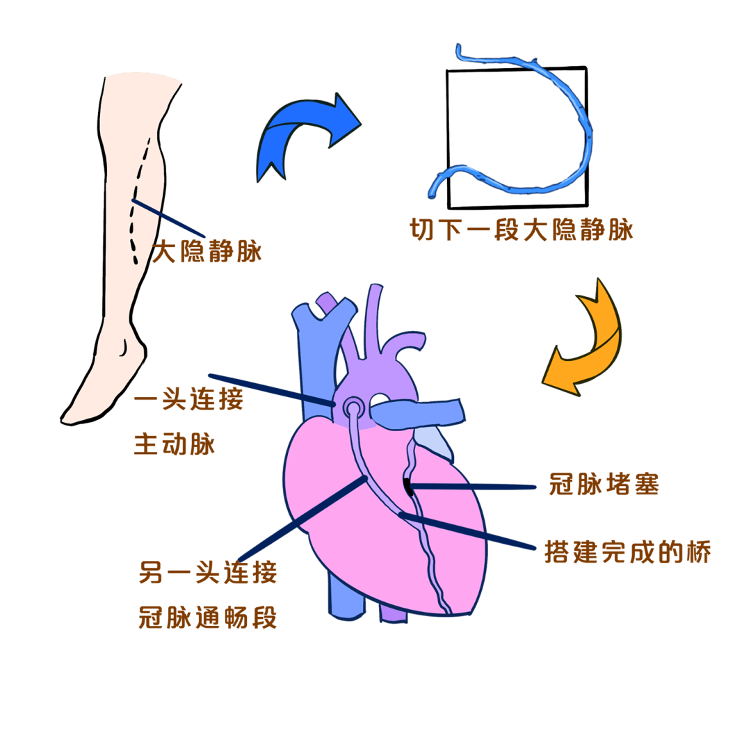 心脏搭桥为什么活不长图片