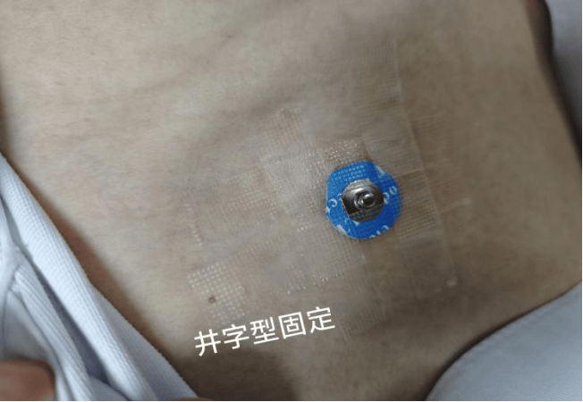 diy 奇招破解电极片过敏困境