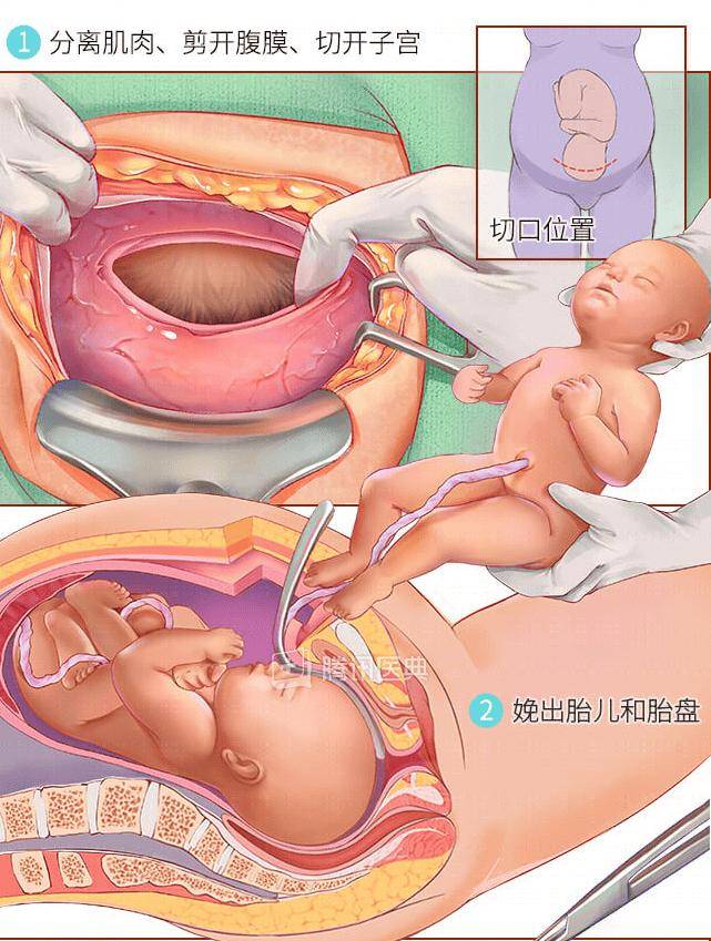 顺产全过程 下面图片