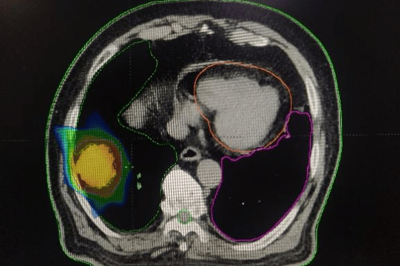 精准放疗：让82岁肺癌患者重燃生命曙光(图1)
