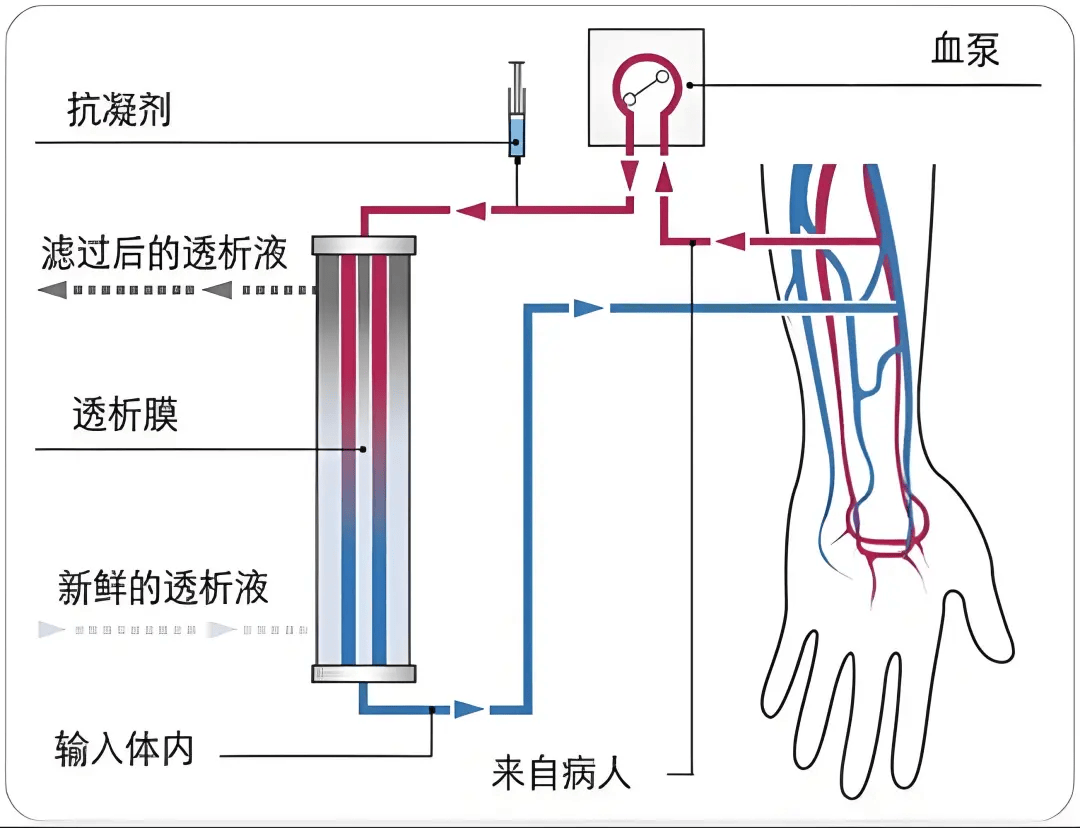 "两针并一针",我院在全省率先开展单针交互血液透析技术,解决患者透析