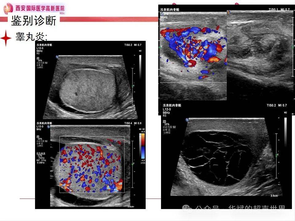 附睾超声测量图图片