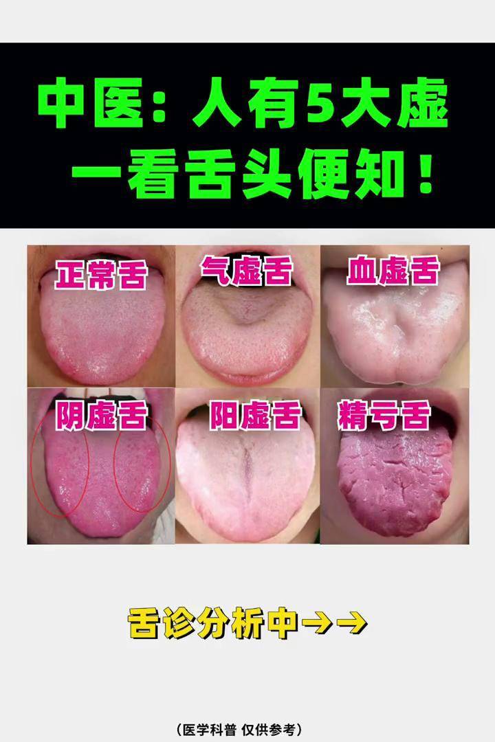 中医舌诊大揭秘:5种舌头的秘密