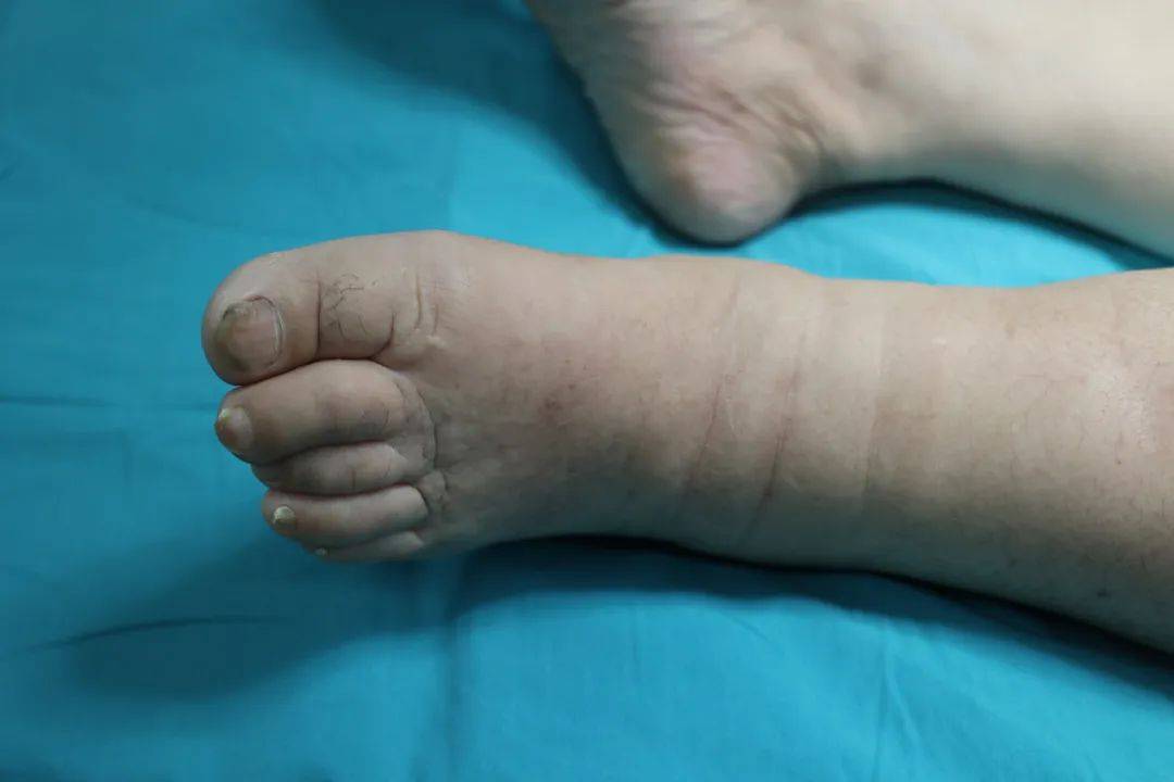 妇科肿瘤手术后,下肢为何肿成"大象腿",看整形外科专家如何巧妙"消肿"