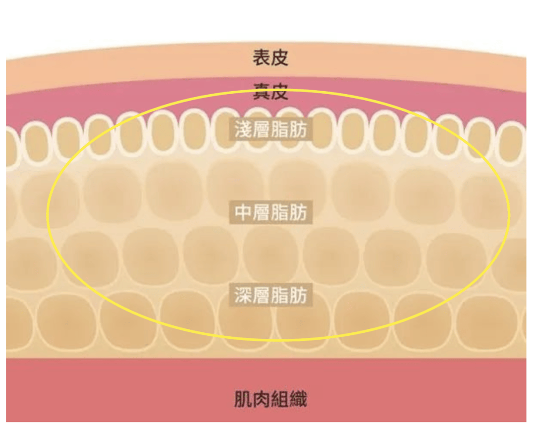 大臀诱惑|自体脂肪vs假体怎么选?