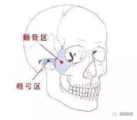 面部颧骨骨折症状图片图片