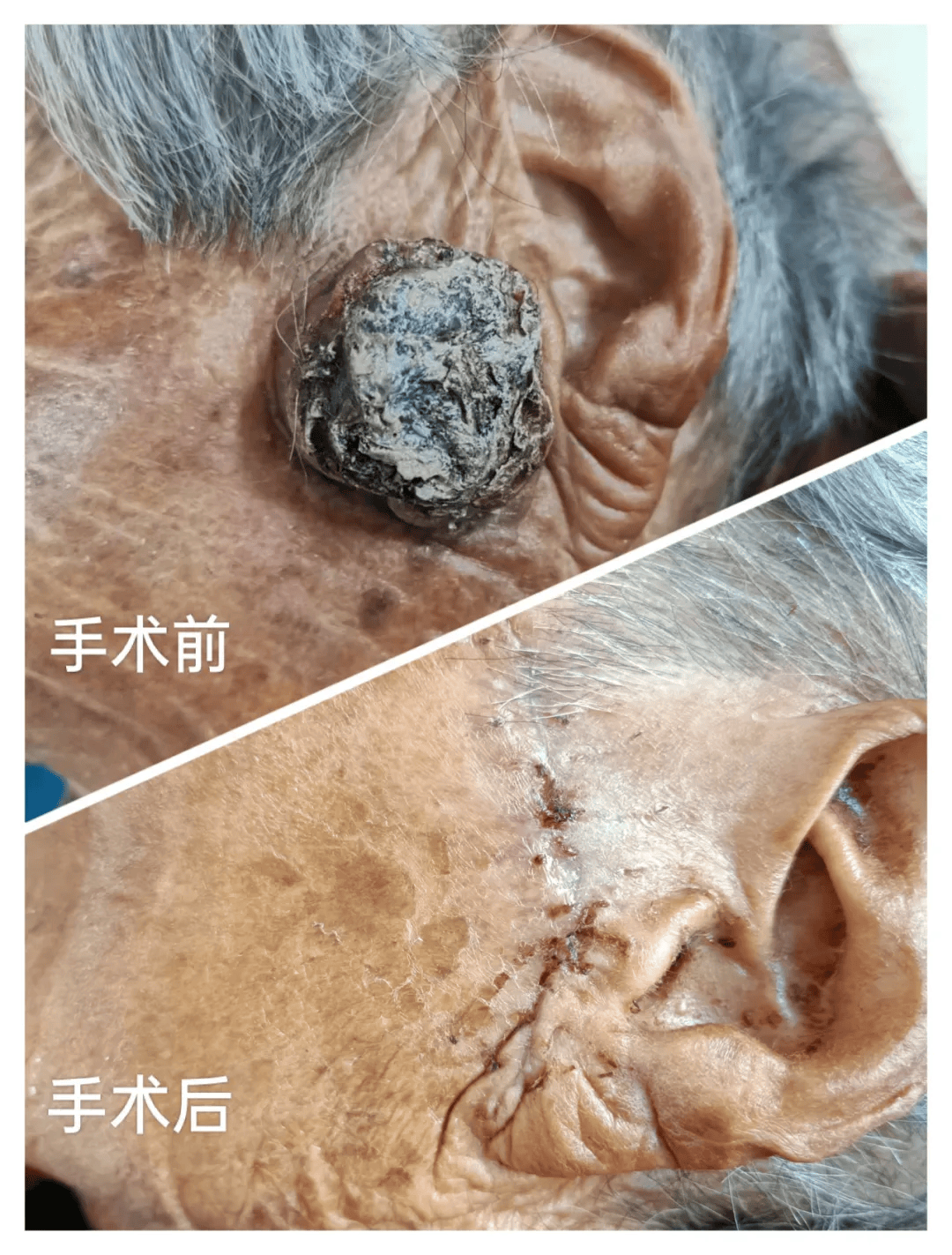 肿物巧切除 妙手修复换新颜