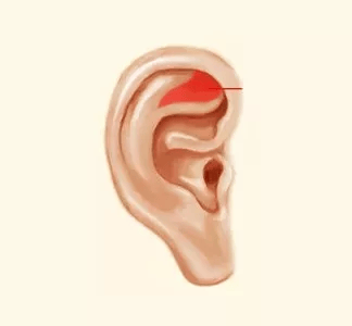 耳朵上的三角区就是三角窝,它对应于人体的泌尿生殖系统,还有交感