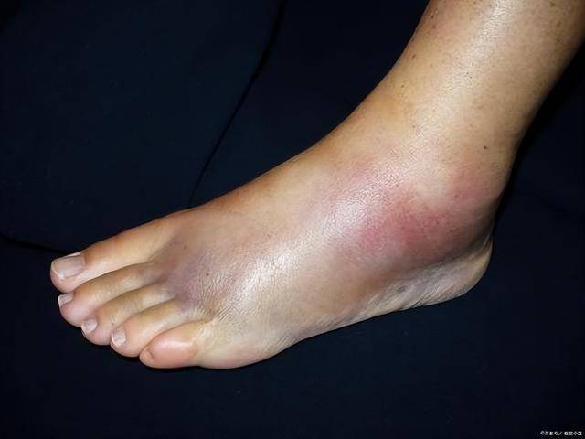 体内有血栓,看脚就知道?提醒:若出现这几种表现,或是血管堵了