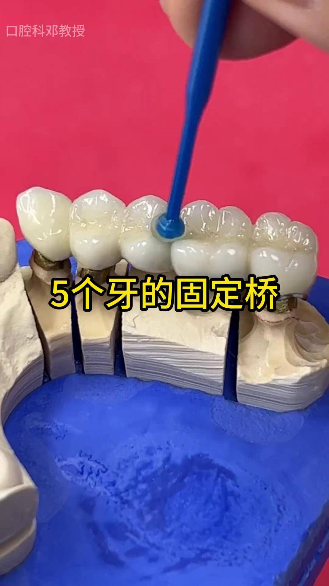 磨3做5的固定桥你觉得怎么样口腔科普固定桥口腔科邓教授