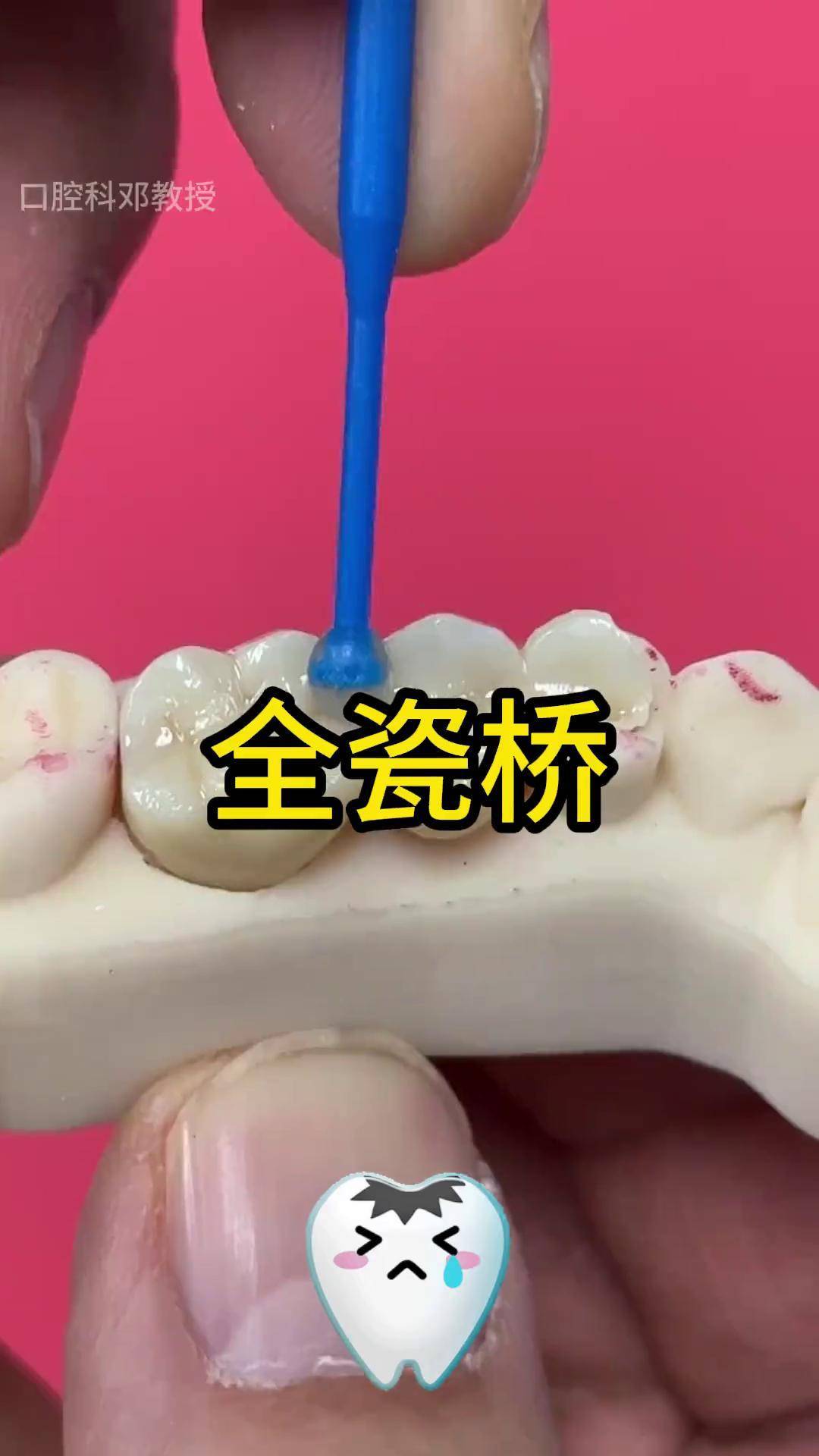 这样的全瓷桥怎么样呢?口腔科普 全瓷牙 口腔科邓教授